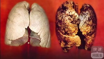 久咳胸痛是老年人肺癌症状 支招这些食物防癌