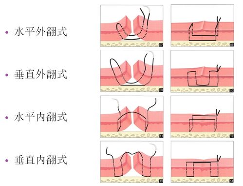 口腔外科常用的缝合技术