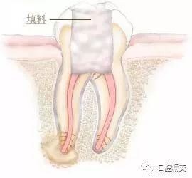 一看就懂 牙齿 根管治疗 全过程图解