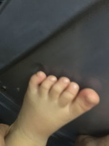 2岁多的孩子脚指头歪的是怎么回事 