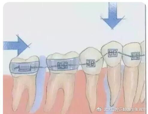 牙齿矫正的原理,原来牙套是这样移动的