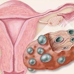 多囊卵巢综合症怀孕(多囊卵巢女性可以自然怀孕吗为什么)