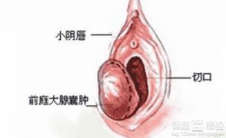 你所不知的女人世界——前庭大腺