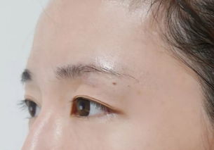 人间医美 关于双眼皮埋线手术和眼部抽脂的 实力 分享