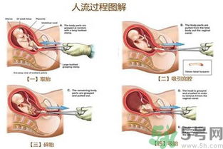 流产后注意什么 人流后饮食要注意什么