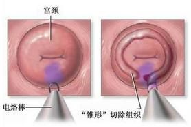 宫颈口硬不成熟是不是很难顺产(宫颈硬宫口难开是什么原因)