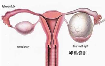 卵巢囊肿患者适合哪些运动 