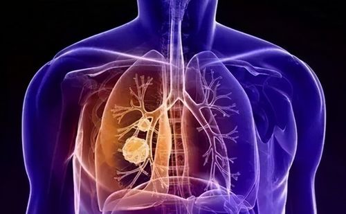 肺结节治疗的两种方式