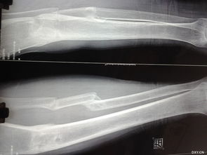 胫腓骨骨折手术过程一例 米粒分享网 Mi6fx Com