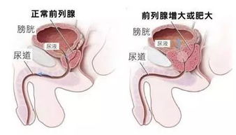 前列腺增生手术 前列腺增生的常用手术方法有哪些