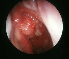 鼻骨瘤的早期症状图片 搜狗图片搜索