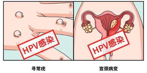 没有性生活,为什么我还是感染了 HPV