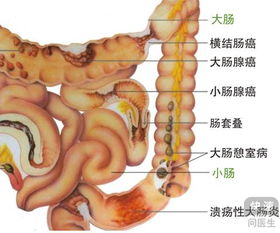 慢性结肠炎的症状