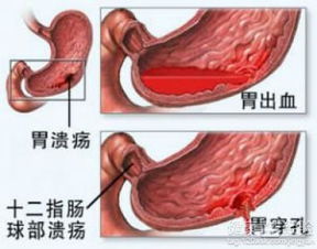 胃溃疡怎么治疗呢