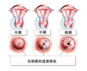 宫颈癌知识早知道