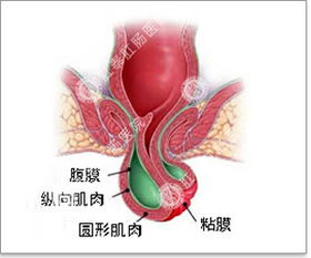 福州医博医院怎么治疗脱肛