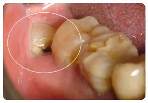 口腔科普丨牙齿矫正为何一定要把那横生的智齿拔掉