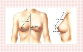 假体隆胸能母乳吗,假体隆胸可以喂奶吗,假体隆胸可以哺乳吗 七丽时尚网 