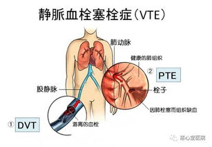 久坐不动,当心静脉血栓危害