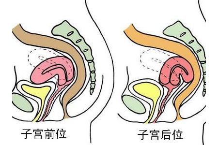 女性子宫出现前位的原因