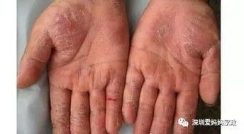 手脱皮的严重是怎么回事 医生提供几个简单方法 