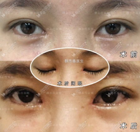 北京的魏志香医生修复内眼角怎么样 我内眼角开大了想找她