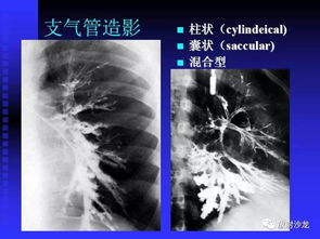 胸X片读片全面分析 肺部常见病的X线诊断 