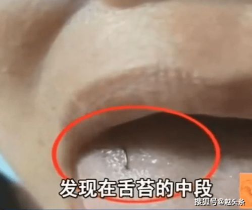 绍兴一家人聚餐,女婿钓鱼前来,结果丈母娘舌头被鱼钩 钩 住了