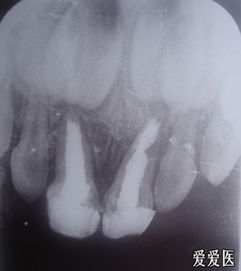 三岁儿门牙根管治疗后牙龈长脓包怎么办