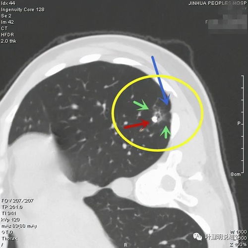 如何减轻肺结节患者焦虑 换个角度看问题