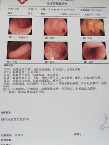 胃窦活检 粘膜组织慢性炎症,灶性肠化,间质水肿 什么意思 吃了雷贝拉唑 马