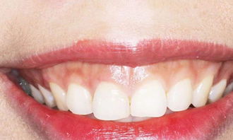 如何正确护理牙齿,摆脱各种牙齿不适,不妨采用这些方法