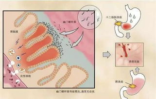 春节聚餐少不了,觥筹交错间千万小心幽门螺杆菌 