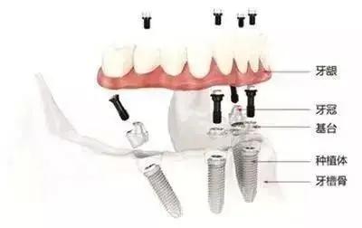 老年人全口牙缺失,缺牙修复刻不容缓