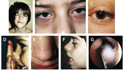 儿童过敏性鼻炎如何治疗 长期用糖皮质激素会有副作用吗