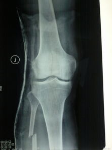左小腿胫腓骨骨折图片 信息评鉴中心 酷米资讯 Kumizx Com