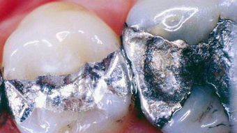 口腔超级科普 火了150年的银汞合金,逐渐消失在口腔的视野