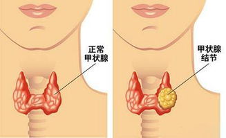 体检查出多个甲状腺结节要紧吗