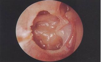 分泌性中耳炎的治疗要点