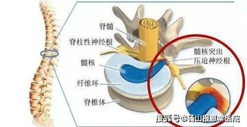 什么是腰椎间盘突出,腰间盘突出怎么治疗比较好呢