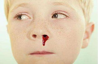 儿童流鼻血的原因(小孩经常流鼻血是什么原因)