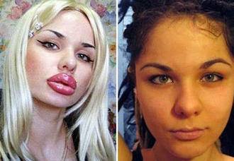 17岁女孩改造自己身体,成世界上嘴唇最大的人