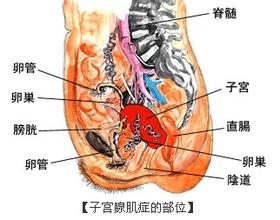 绝经子宫腺肌症如何保健 