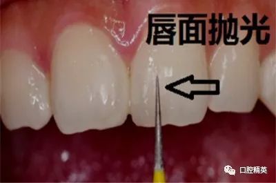 门牙龋坏,树脂修复一例