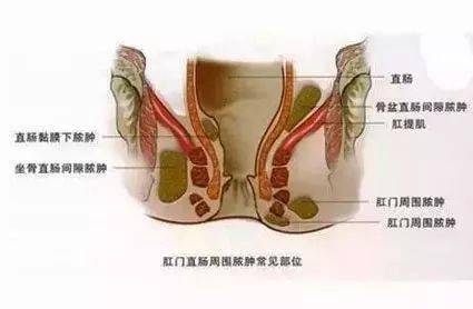 肛门痛别大意,肛门痛也会致命