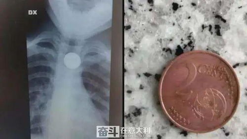 误食硬币卡喉咙里怎么办 意大利医院让吃面包顺下去惹争议