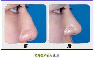 驼峰鼻的整形方法是什么
