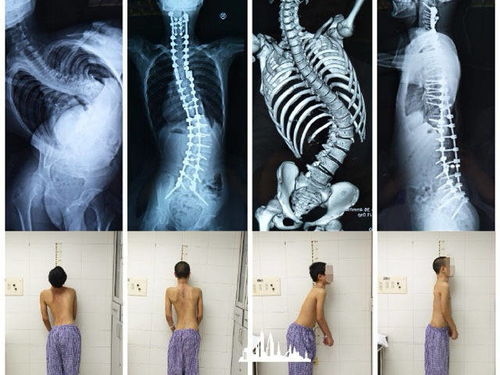 脊柱健康影响一生,脊椎骨坏死消失引起脊柱侧弯还能站起来吗