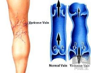 双下肢静脉曲张症状是什么 怎么治疗好