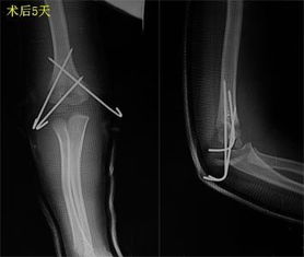 儿童肱骨髁上骨折 父母需要知道的事情